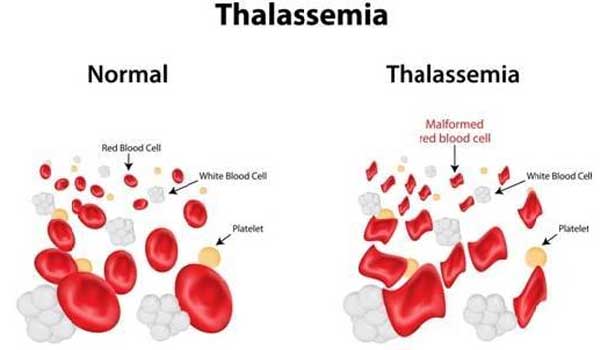 தாலசீமியா நோய் ஏற்படுத்தும் உடல் பாதிப்புகள் | Thalassemia